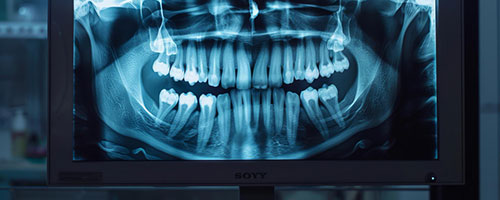 Dental-xray-on-a-screen
