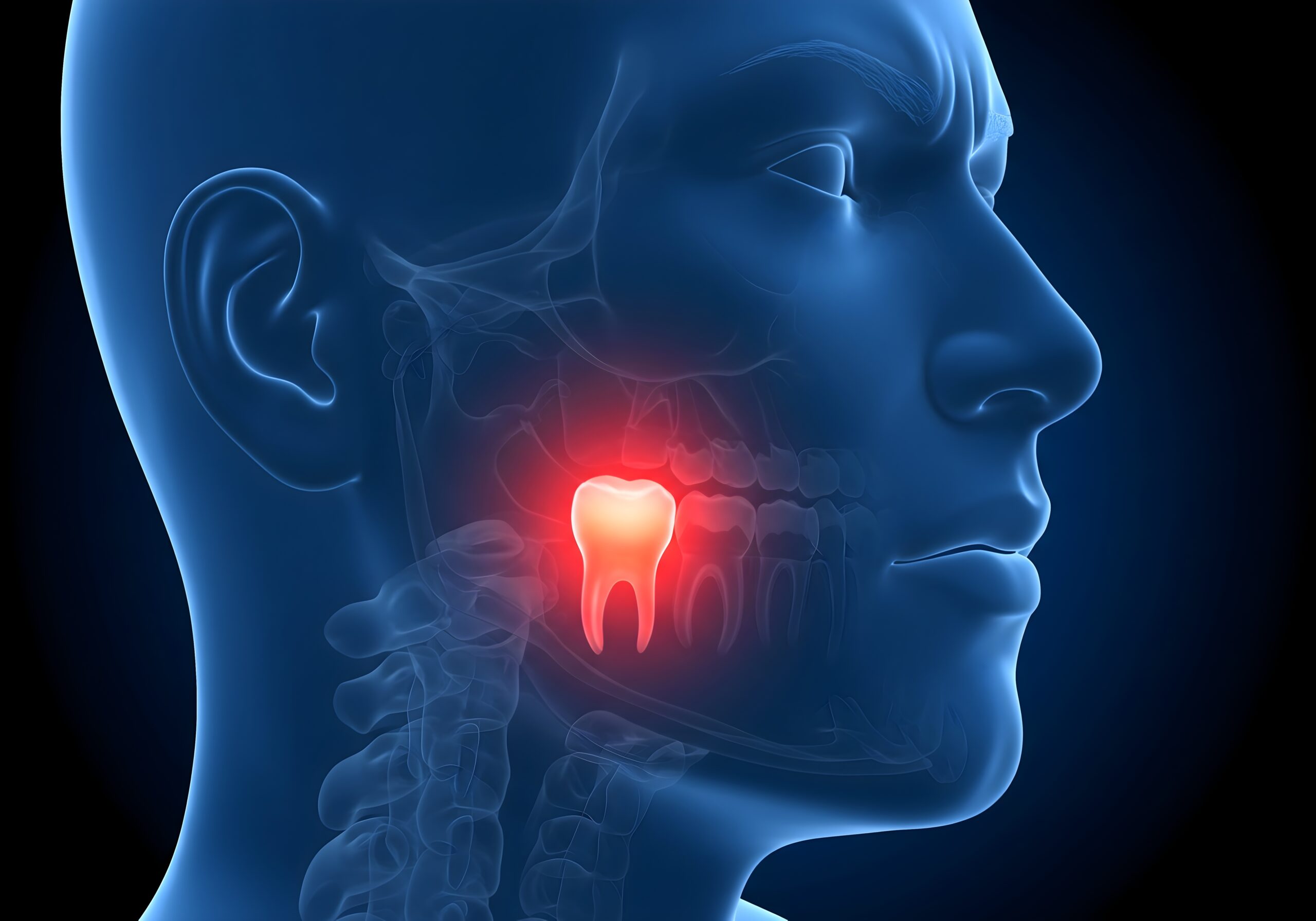 Read more about the article Wisdom Tooth Extraction Indications